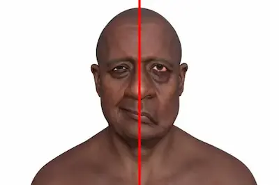 Federated Facial Paralysis Detection